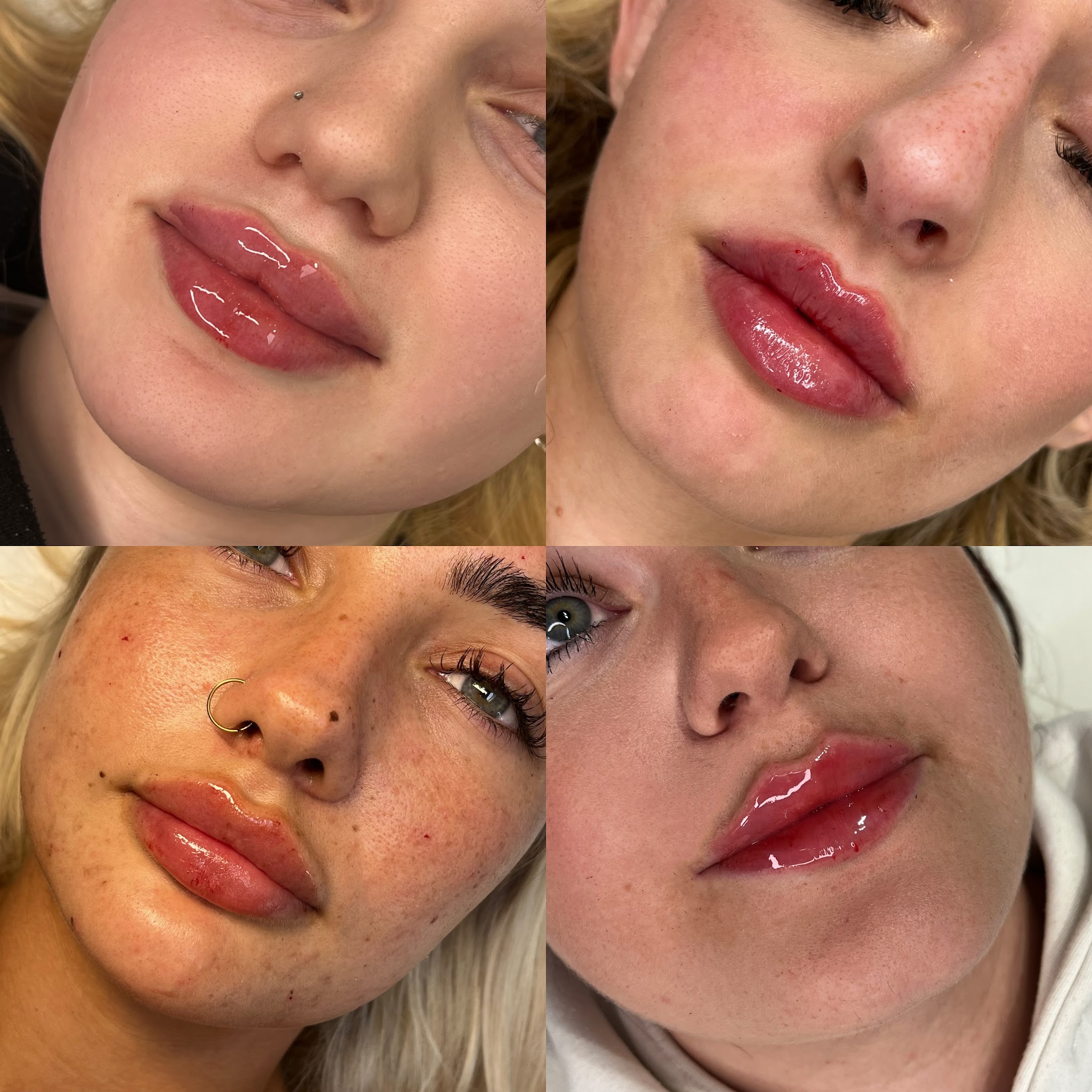 Four lip filler results side by side, before and after