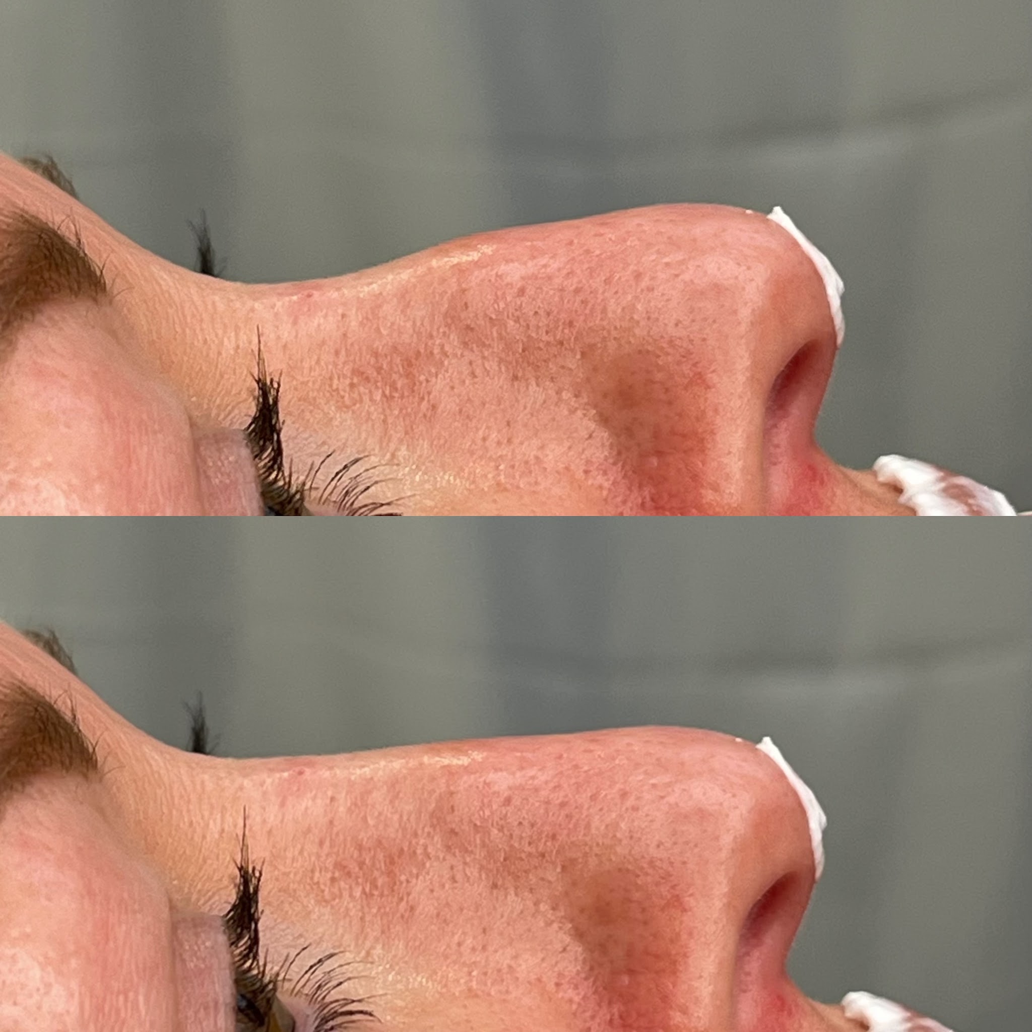 Nose profile before and after, side view