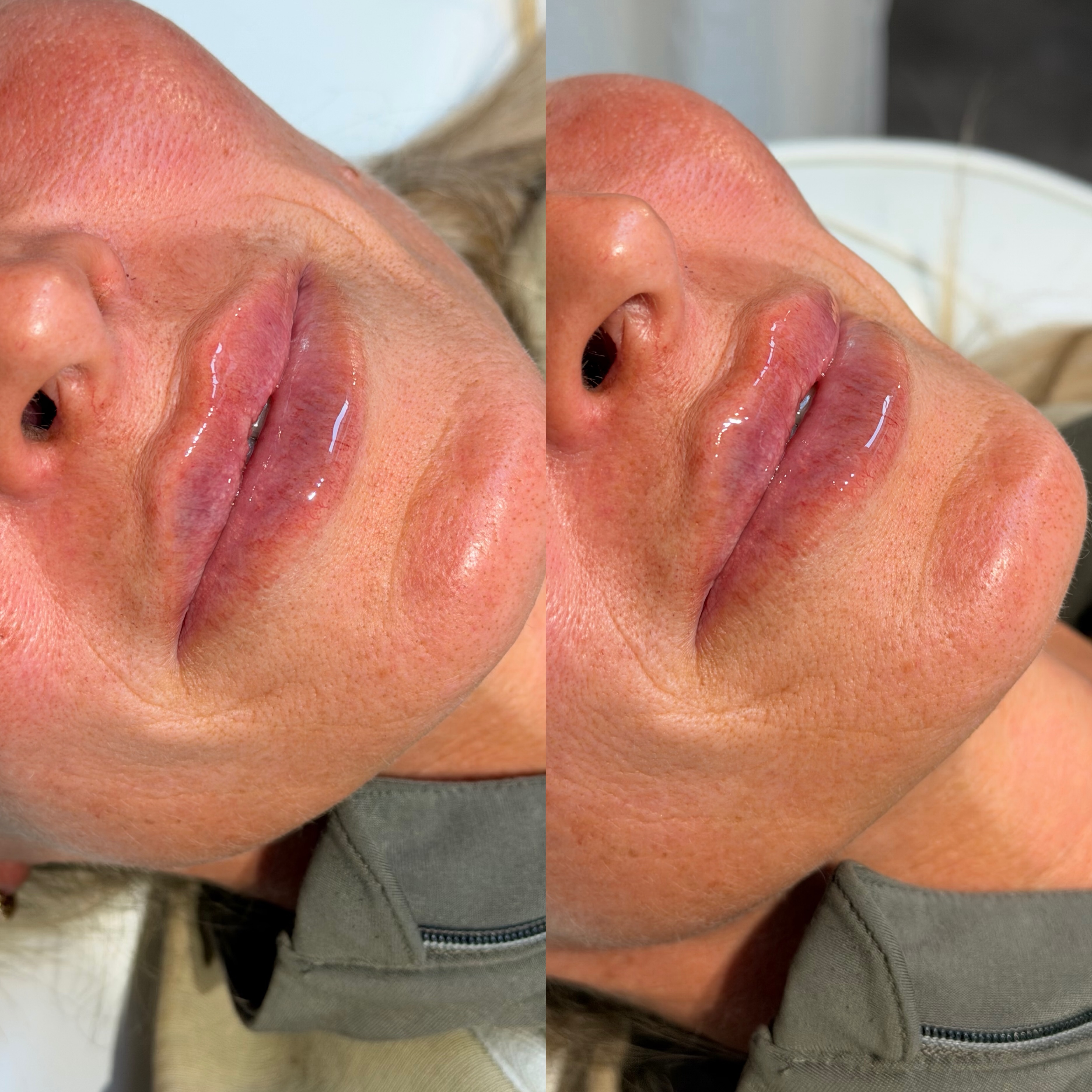 Lip filler before and after in side profile