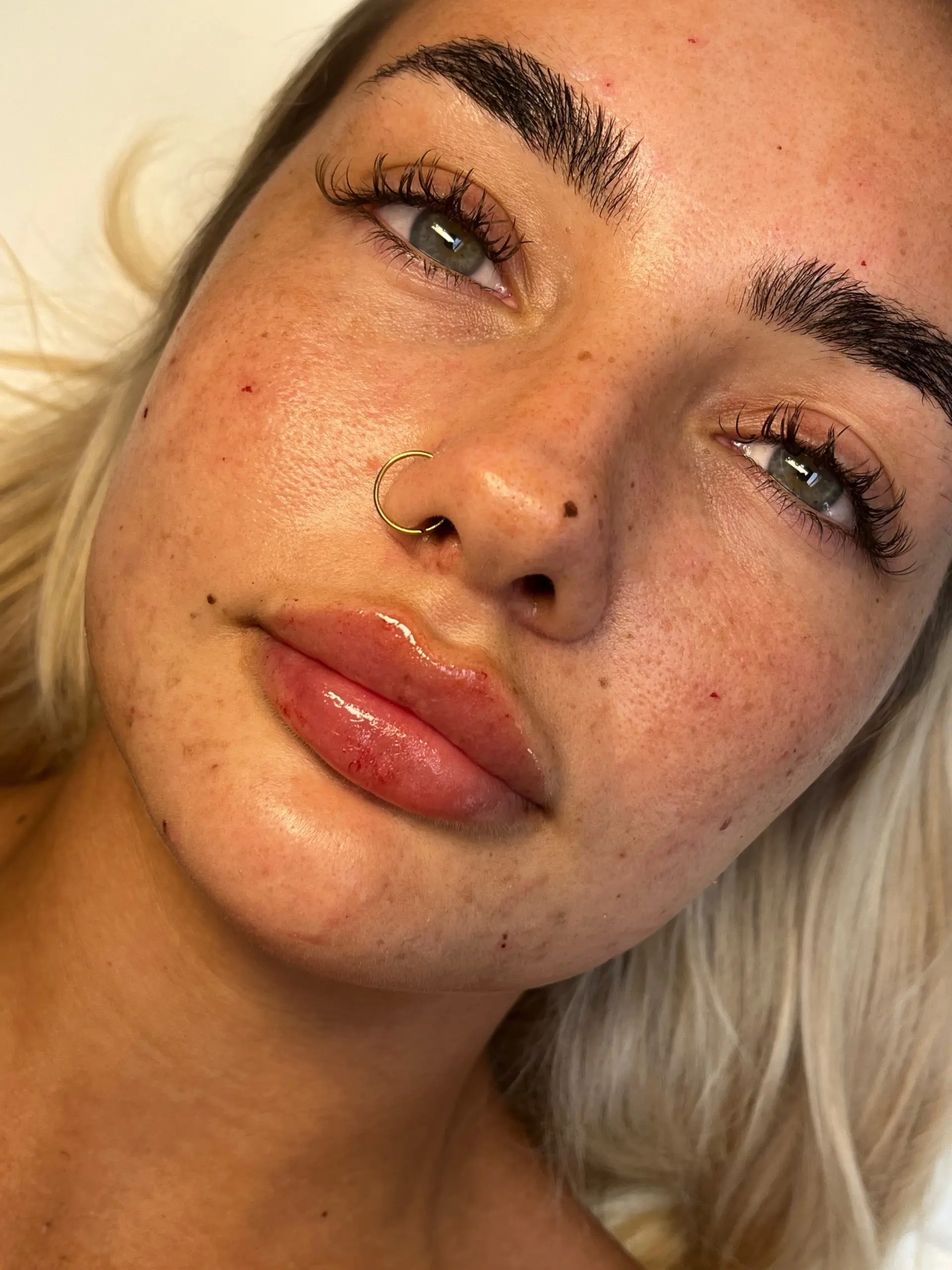 A lip filler result at The Beauté HQ